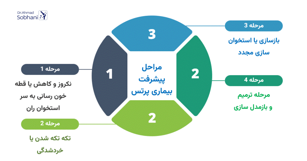 بررسی مراحل پیشرفت بیماری پرتس