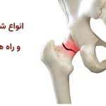 انواع شکستگی لگن و راه‌های درمان آن