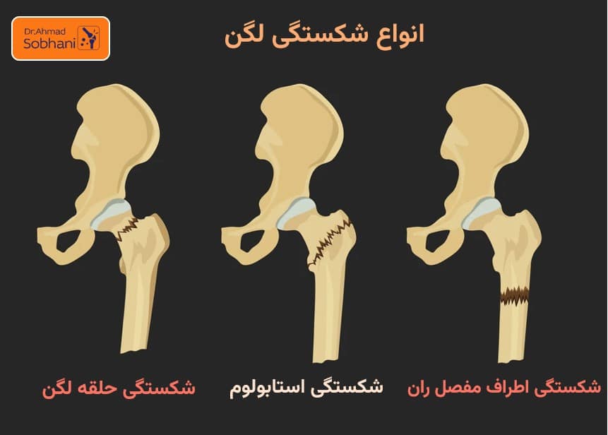 بررسی انواع شکستگی لگن