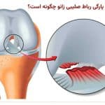 روش های درمان پارگی رباط صلیبی زانو چگونه است؟